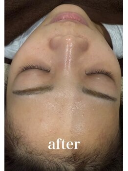 ドクターエイチ 四ツ橋堀江店(Doctor.H)/ハイドロ+ハーブ＋無針水光注入