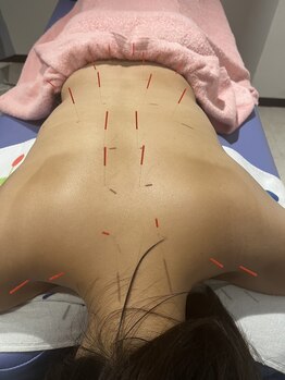 松戸駅前鍼灸院 整骨院/全身鍼