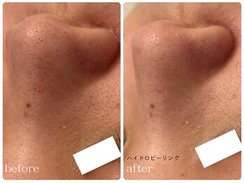 メゾンリュバン 梅田店(Maison Ruban)/毛穴洗浄（ハイドロピーリング）