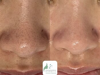 メゾンビューティーポピンズ 恵比寿(maisonbeauty poppins)/毛穴特化マツヤニワックス脱毛