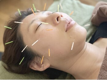 まこと鍼灸院の写真/『美容鍼って実際どうなの？』そんな不安も丁寧なカウンセリングで解消◎内側から弾むようなハリ艶美肌へ♪