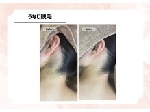 アルゴ 福津店(ALGO)/【うなじ】ワックス＋光脱毛