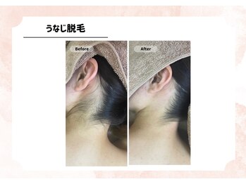 アルゴ 福津店(ALGO)/【うなじ】ワックス+光脱毛