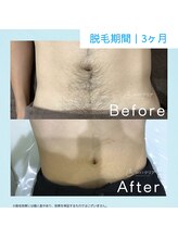 メンズクリア 武蔵小杉店/【メンズクリア】お客様の施術例