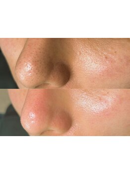 毛穴ケアをしたい