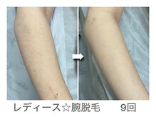 ナルシス/【脱毛】腕9回の変化★