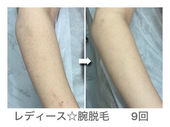 ナルシス/【脱毛】腕9回の変化★