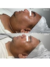 ナチュールムーン(Nature moon.)/ハーブピーリング