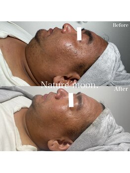 ナチュールムーン(Nature moon.)/ハーブピーリング