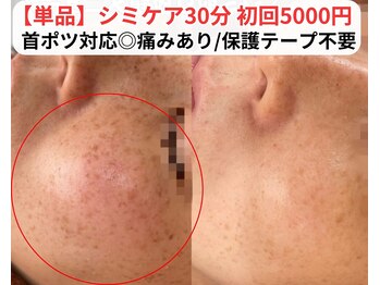 ベルファーム(Belle Femme)/シミ改善へ☆