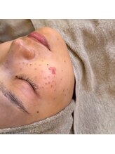 ビューティーサロン ココ(Coco～)/シミケア施術直後