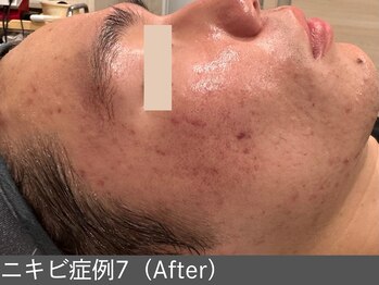 オアシスラグーン(OASIS LAGOON)/ニキビ改善(症例7 after)