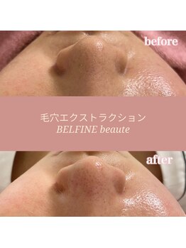 ベルフィーヌボーテ(BELFINE beaute)/毛穴エクストラクション
