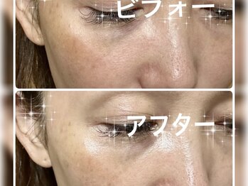 ブルーム(BLOOM)/REVI陶肌トリートメント