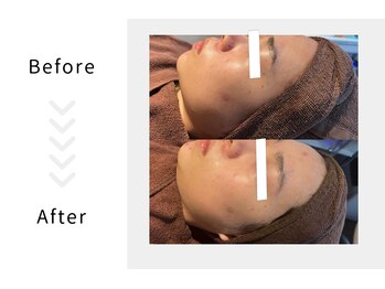 アブニールブリヨン/ハーブピーリング　Before After