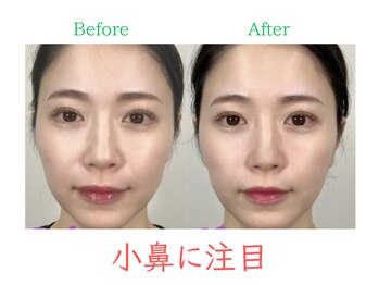 ラプリ 福岡博多店(Raplit)/隆鼻+輪郭・小顔矯正 美鼻/小顔