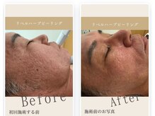 クリア 麻布十番(CLEAR)/リベルハーブピーリング