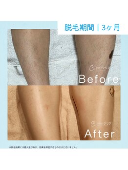メンズクリア 武蔵小杉店/【メンズクリア】お客様の施術例