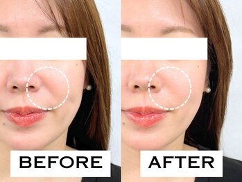 ビハリスト 新宿マルイ本館/ほうれい線が改善!