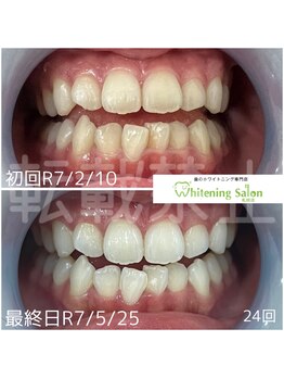 ホワイトニングサロン 札幌店/【ホワイトニング】#札幌#大通り