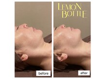 ヒジ(Life Salon)の雰囲気（レモンボトル導入！フェイスライン/二重顎対策に◎）