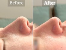 ボーンオム(Born Homme)/毛穴洗浄＋美容液導入：30代女性