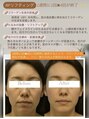 ミリュール(Millule)&nbsp;いつからだって変われます。たるみにお悩みの方へ５回で完了です