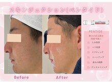 ユアーズ ビューティー(YOURS beauty)/スキンジェクション