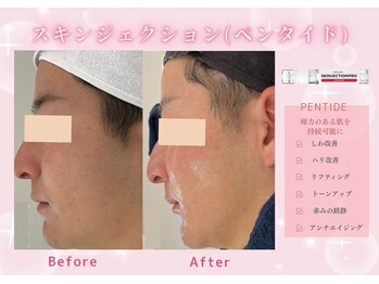 ユアーズ ビューティー(YOURS beauty)/スキンジェクション