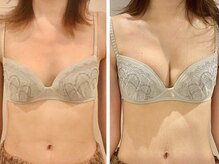 リール 恵比寿店(RIRE)/バストアップ症例【広尾恵比寿】