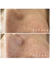 メナードフェイシャルサロン 岐阜茜部/ホワイトニング/紫外線/透明感