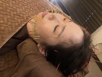 リノア鍼灸院(LINOA)/小顔やリフトアップに◎