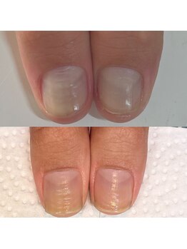 ウェルズユキ(well's yuki)/トラブル爪/改善したい爪