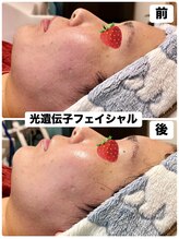 ローズ 下松(ROSE)/トラブルのないお肌に変化