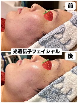 ローズ 下松(ROSE)/トラブルのないお肌に変化