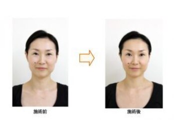 飯能ひだまり整骨院/小顔矯正(1回施術後)