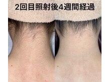 エジェリビューティー 恵比寿(egerie beauty)/美しいうなじ作り脱毛2回照射後