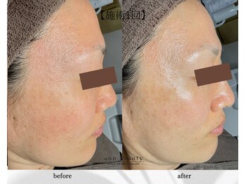 アン ビューティー(ann beauty)/施術1回【症例写真】