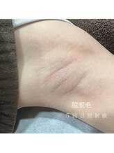 ペペ(pepe)/脇脱毛体験　【両脇　５００円】