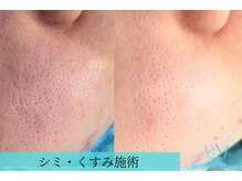 リメイクビューティークリニック(REMAKE BEAUTY CLINIC)/２回：お肌の根本改善！