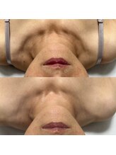 キーオブフェイス(Key of Face)/お悩み【首のしわ・たるみ】