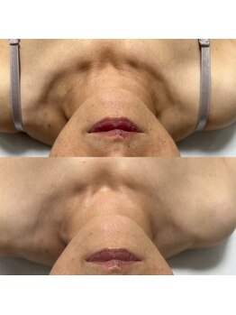 キーオブフェイス(Key of Face)/お悩み【首のしわ・たるみ】