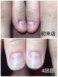 深爪矯正　実績サロン♪