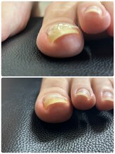 リリ(lili)/巻き爪矯正2回目（左親指）