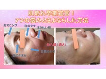 7つの悩みとさよならした方法シワ・クマ・ほうれい線・赤ら顔