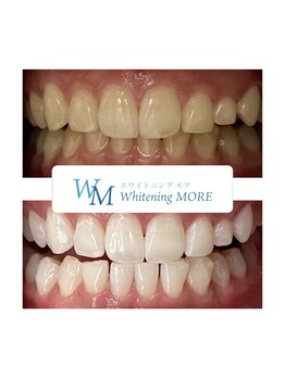 ホワイトニング モア(Whitening MORE)/ビフォーアフター