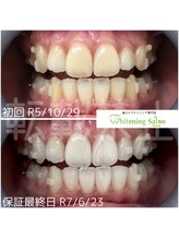 ホワイトニングサロン 札幌店/【ホワイトニング】#札幌#大通り