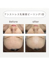 ノドカ 新市街店(NODOKA)/気になる赤みやごわつきのケアに