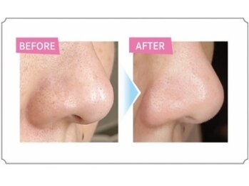 モット いこらもーる泉佐野店(mot)/毛穴洗浄ハイドロスプラッシュ