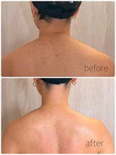 バービーフェイス 恵比寿(Barbie Face)/凝り固まった肩こり徹底改善